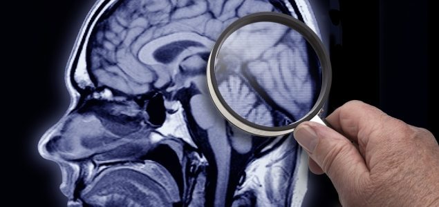 Cerebro-lupa-Alzheimer-635-GETTY