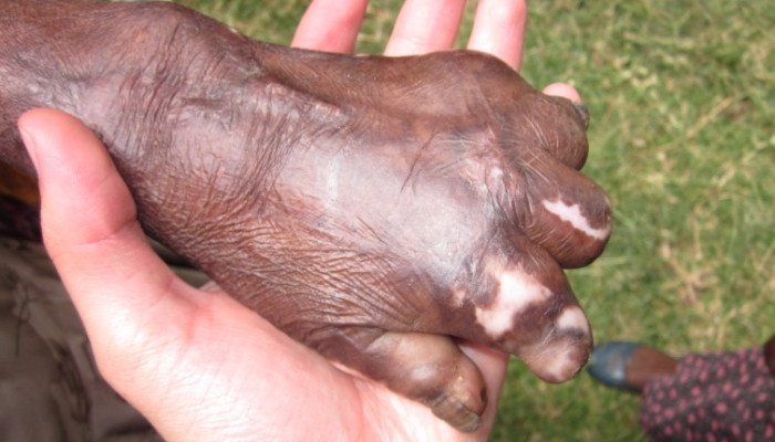 LEPRA-e1453745968379-700x400