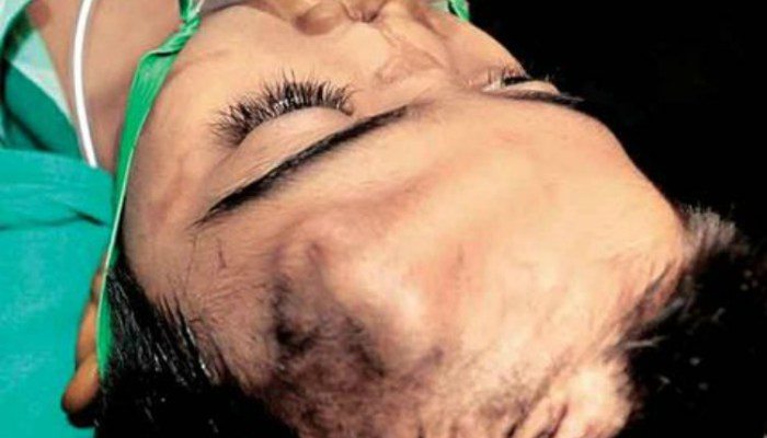 Arun-Patel-deformado-neumonia-despues_MILIMA20160706_0038_11