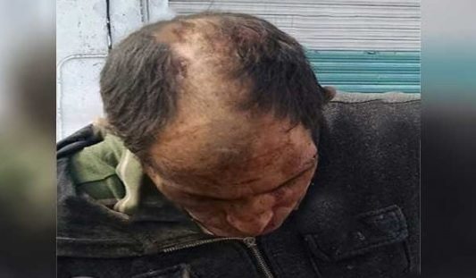 Calvicie-cabello-Toluca-Metepec